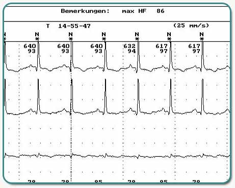 10-Sekunden-Ausschnittsvergrößerung mit normalem Sinusrhythmus.